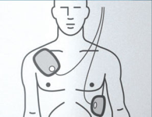 AED Pad Placement